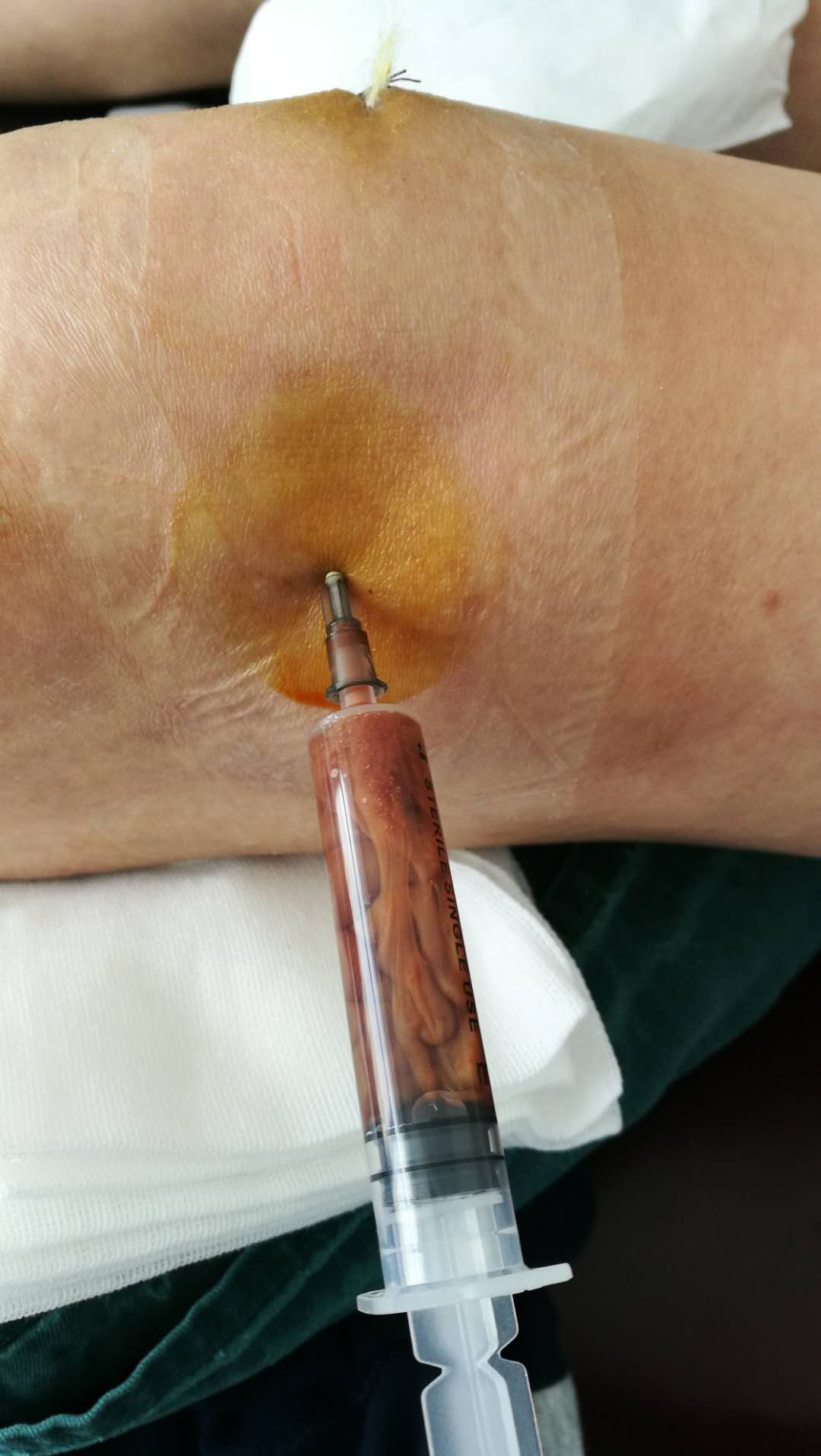 膝盖积水用烤灯能烤好吗?粗盐呢?医生:明确诊断针对治疗是关键