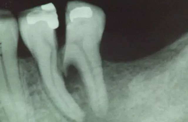 牙齿隐裂拔牙需要种植吗,牙齿裂一半深度还需要拔牙吗