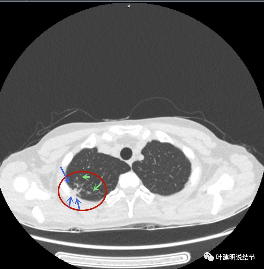 临床诊断孤立性肺结节,空洞型结节一般是什么性质
