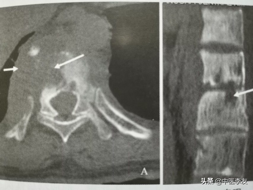 腰椎骨结核治愈后出现腰疼,脊柱结核腰痛怎么治