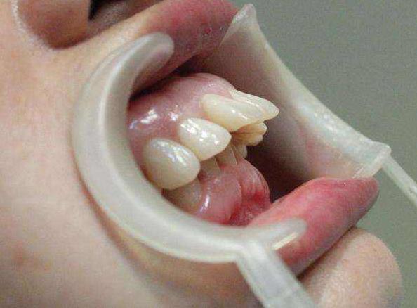 严重的龅牙可以磨掉吗,严重龅牙可以矫正吗