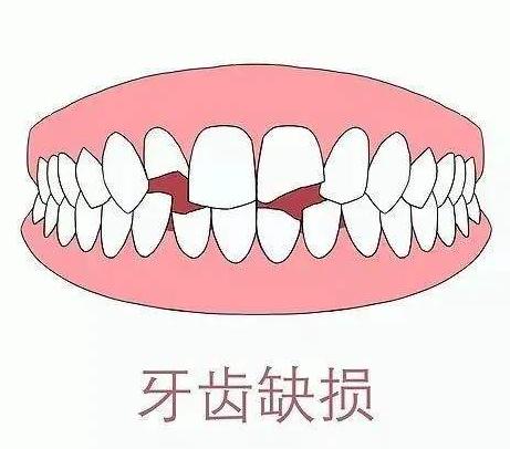 种牙失败取出骨粉会损害牙槽骨吗,牙槽植骨一定要自体骨粉吗