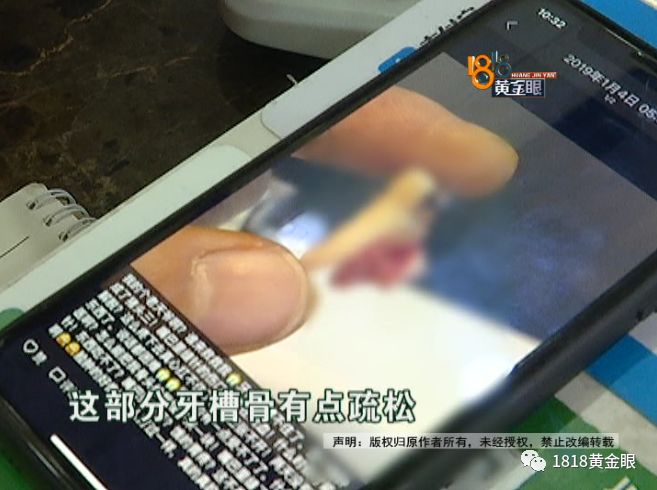 两次拔牙中间需要间隔多久,两次拔牙必须是一个医生吗