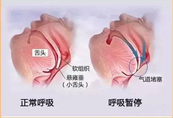 osa睡眠呼吸暂停综合征,什么是睡眠呼吸暂停综合征啊