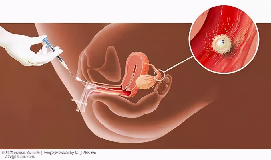 人工授精需要什么步骤,人工促排和人工授精