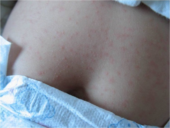 发热性皮疹,成人发热伴皮肤出疹