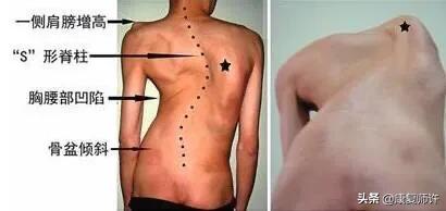 成人肋骨外翻危害,为什么会肋骨外翻出大包