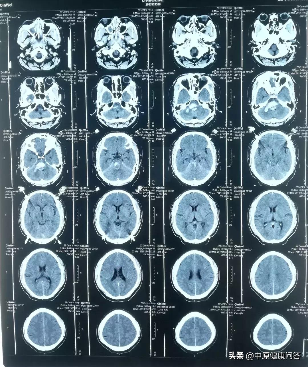 脑干出血发病时的急救常识,40岁突然得脑干出血昏迷有点知觉