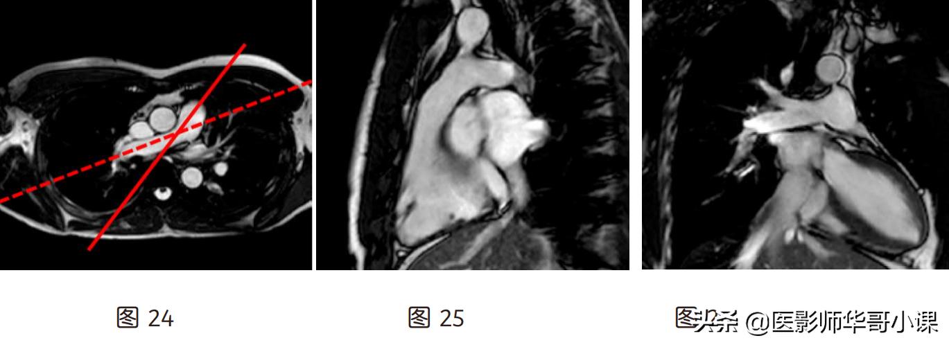 磁共振心脏扫描标准切面,心脏mri扫描定位