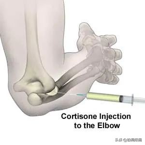 做网球肘操能治愈网球肘吗,做家务胳膊痛什么原因