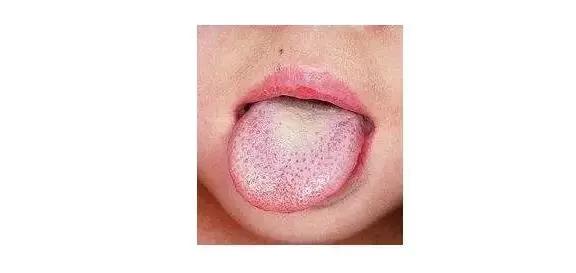 猩红热4岁儿童的治疗方法,10岁儿童猩红热症状及治疗方法