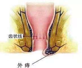 痔疮知识动画讲解,痔疮科普15秒