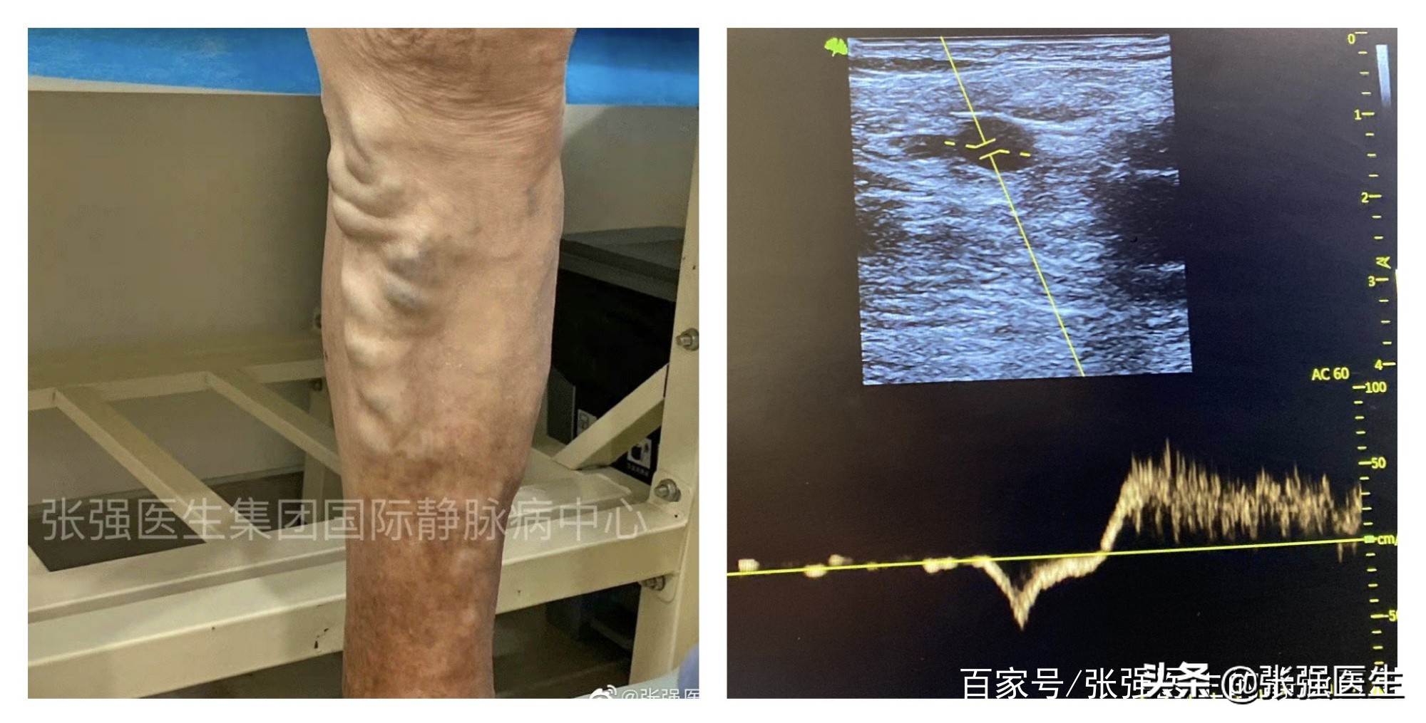 糖尿病会导致精索静脉曲张吗,糖尿病人小腿出现静脉曲张