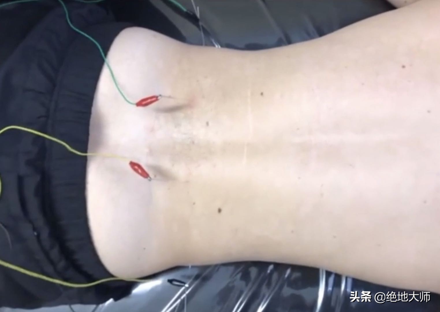 亚急性腰痛康复治疗,急性腰突压迫神经自然恢复要多久