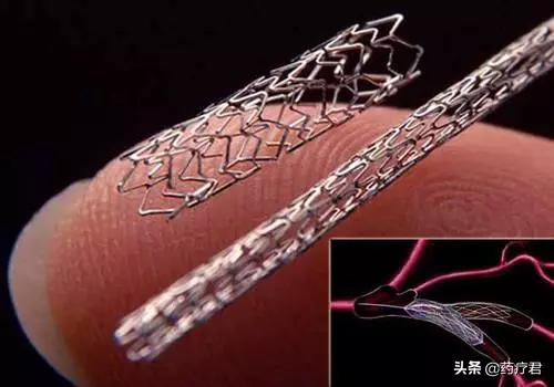 装上心脏支架能活多少年,做心脏支架以后能活多少年