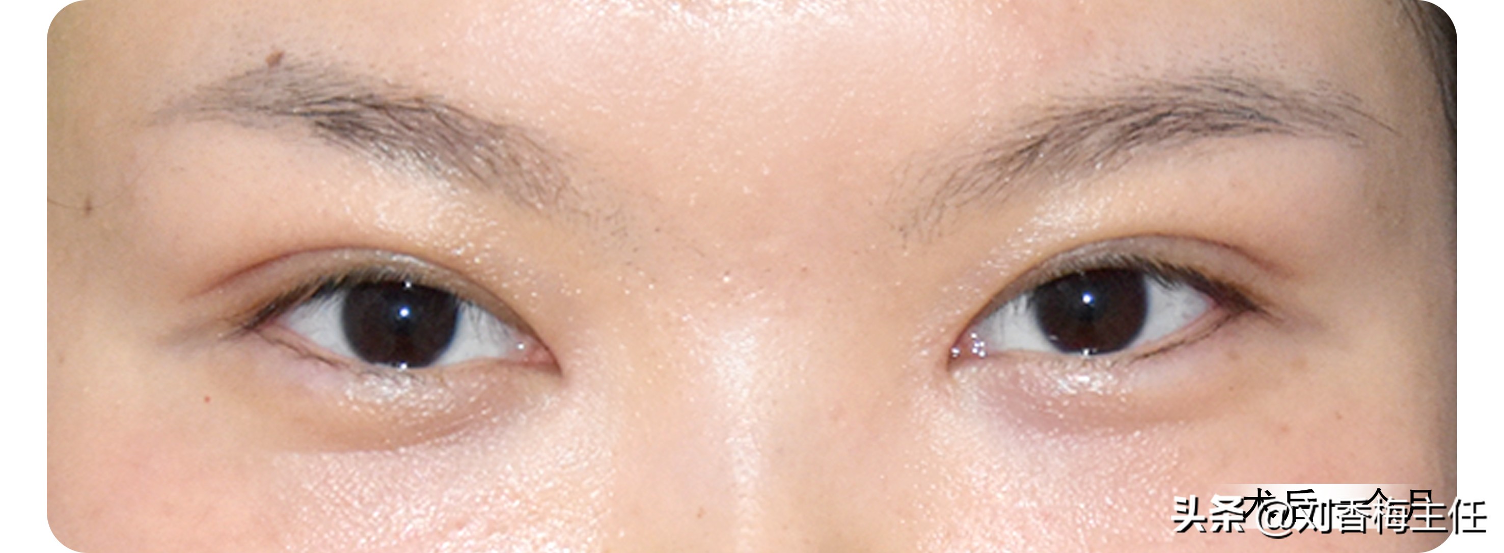 双眼皮恢复过程中不一样宽正常么,三点定位双眼皮恢复10天过程图