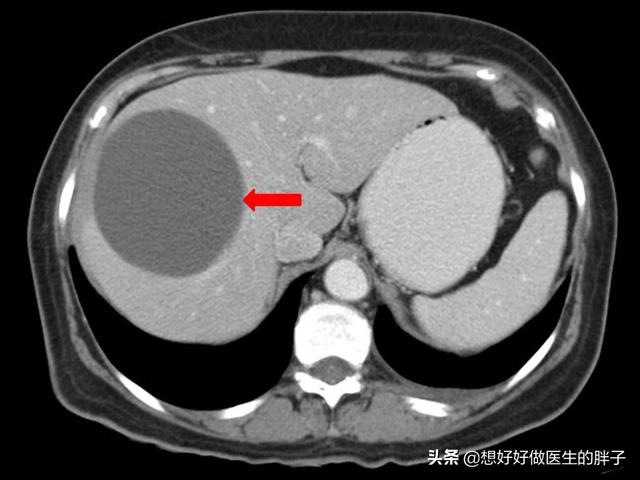 辟谣囊肿手术,得了囊肿必须切除么