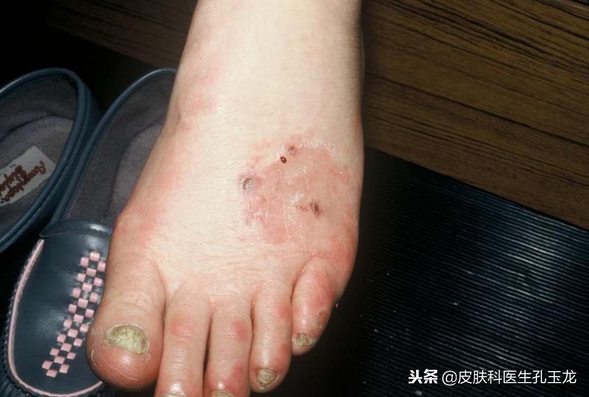 角化型足癣脚痒有死皮,皮肤科专家治脚气