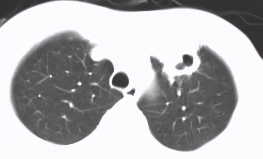 肺结核防控诊疗方案,成功治疗肺结核病的关键