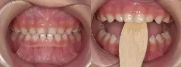 小朋友牙齿地包天矫正方法,牙齿地包天多大矫正最合适