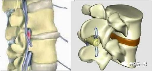 腰椎间盘突出正确睡姿及锻炼方法,腰椎突出及骨质增生正确睡姿图片
