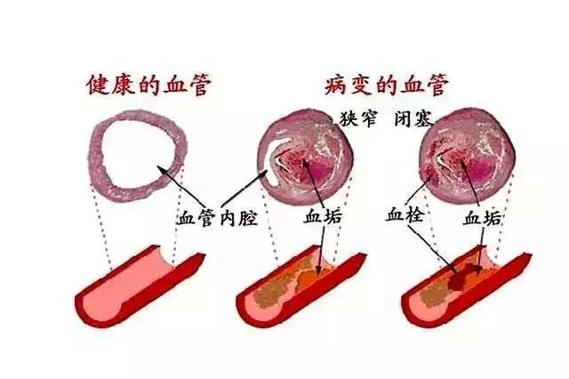 血栓栓住腿部怎么痊愈,血栓栓住胳膊怎么好得快