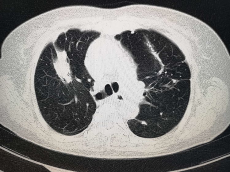 5个小故事：肺结核、脑梗死、车祸，这些意外发现的肺癌都能治