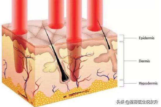 做光子嫩肤前后应注意事项,关于做光子嫩肤的分享