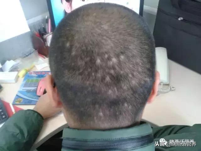 斑秃饮食食谱一览表,斑秃须注意饮食调理