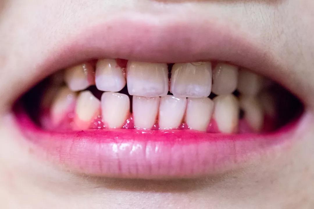 护牙釉质的牙膏叫什么牙膏,防蛀牙牙膏推荐前十名儿童