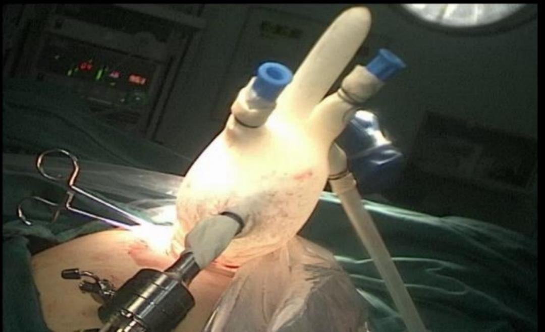 宫外孕微创手术的伤疤要涂什么药,宫外孕手术会不会留下伤疤