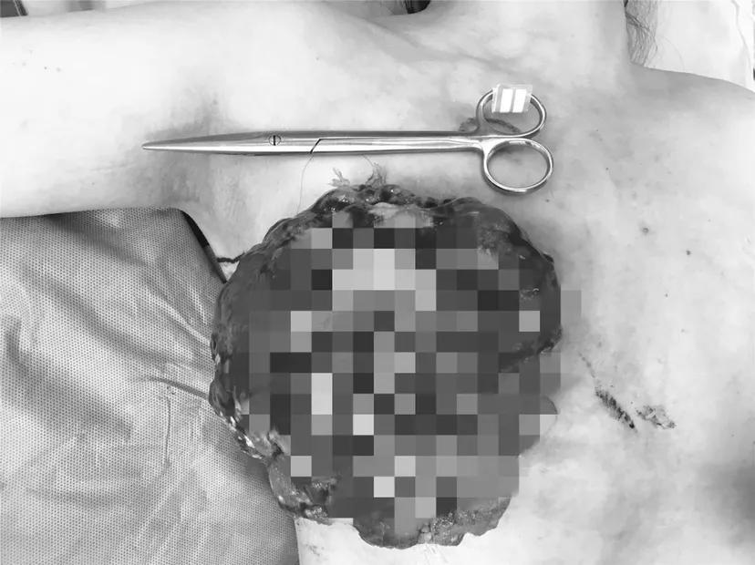 老人乳房外面长菜花瘤,女性右侧颈部长蚕豆大小硬块