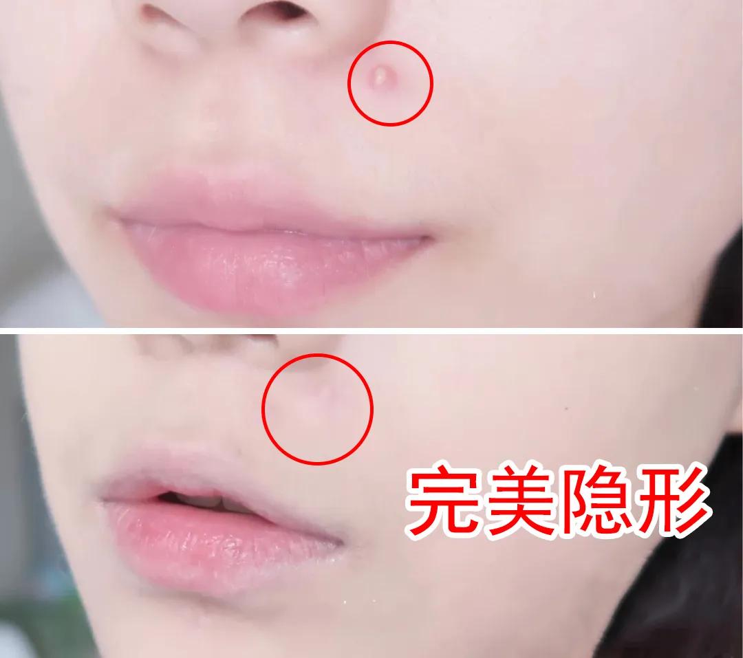 片仔癀淡化痘印凝胶,片仔癀祛痘痘贴有用吗