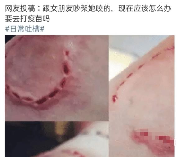 女朋友吵架被咬了打疫苗,被女朋友咬了需要打破伤风