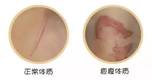 以前不是疤痕体质现在怎么留疤了,受伤了愈合之后为什么会留疤