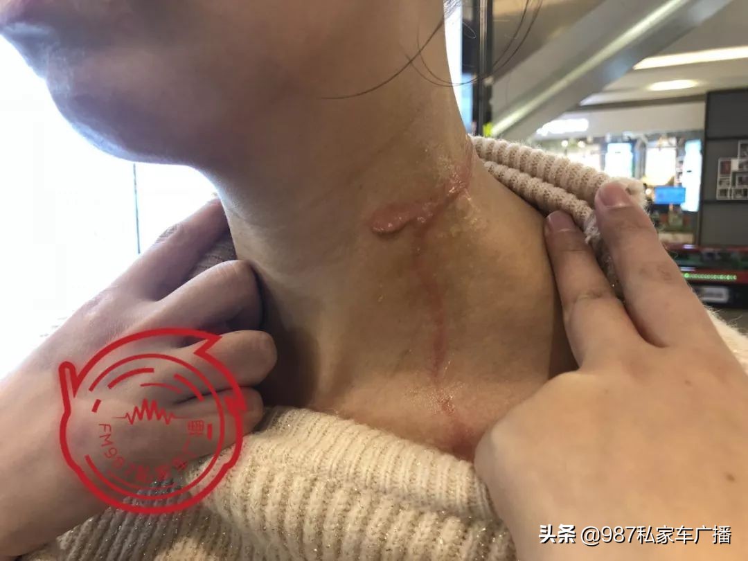 福州一女子进店美发,竟遭滚烫蒸汽喷射……疤痕吓人!