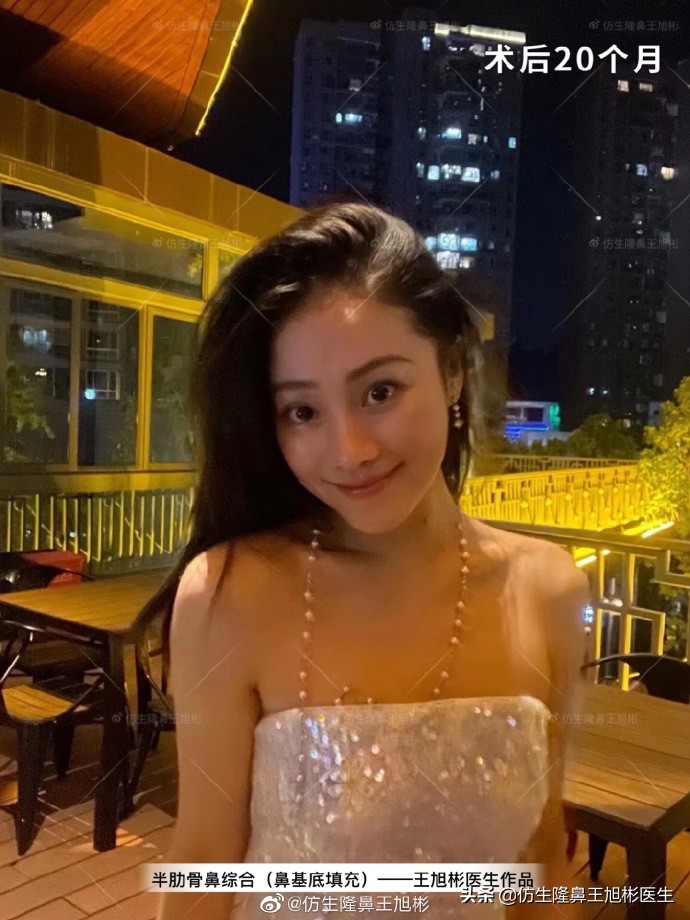 那些被鼻子“封印”颜值的鼻综合/修复案例|广州鼻整形