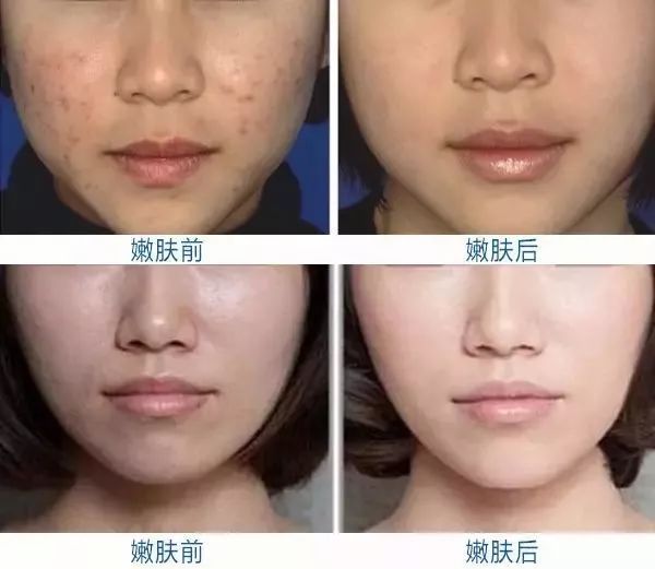 光子中微子区别,光子opt和mtt的区别