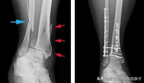 小腿腓骨骨折保守治疗多久能走路,小腿骨折保守治疗多久能恢复正常