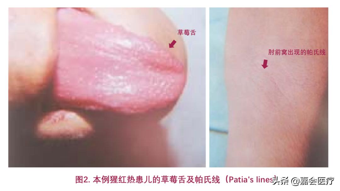 孩子只有草莓舌和发热是川崎病吗,川崎病草莓舌的症状