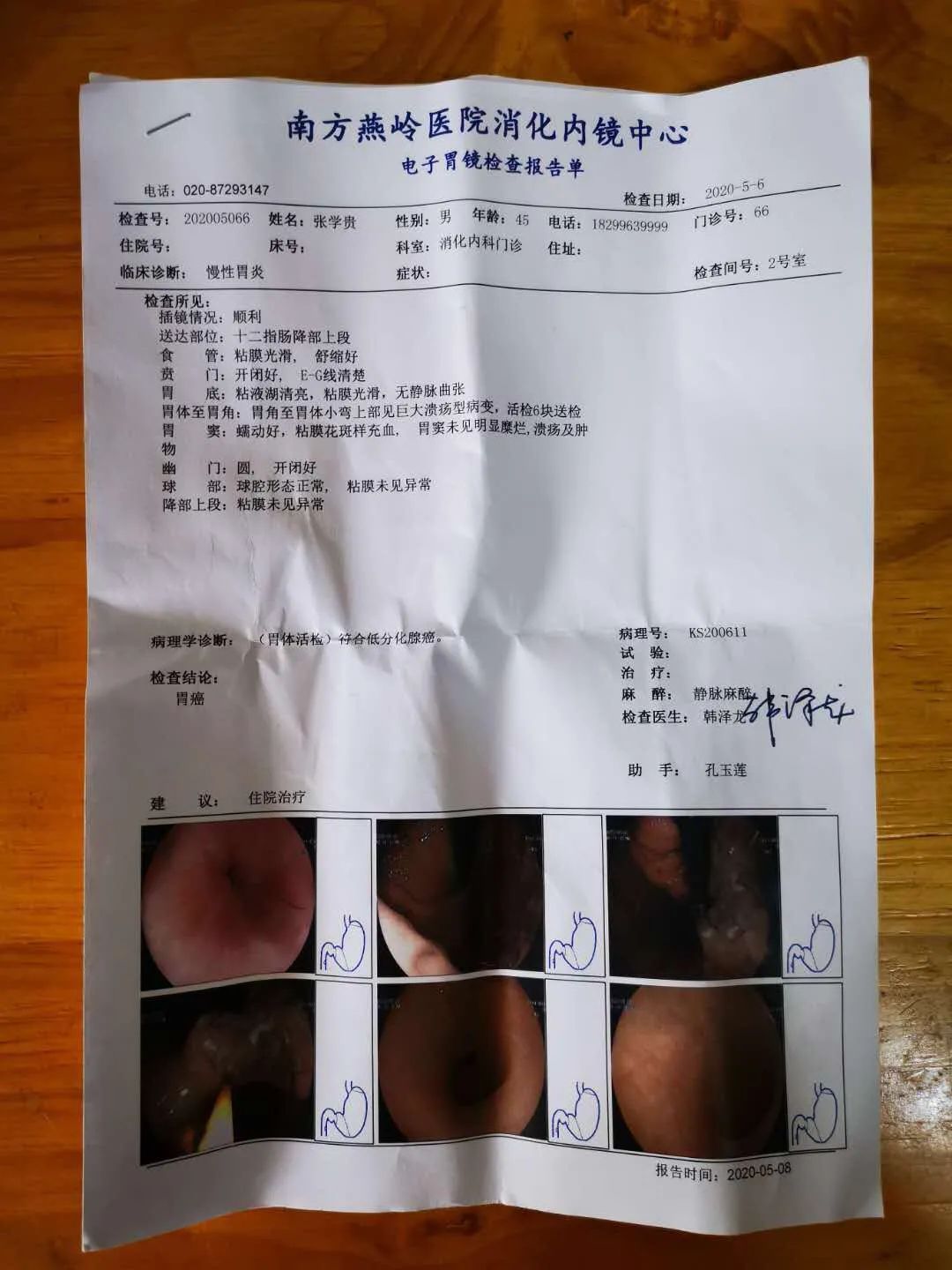 胃癌已转移到腹膜了严重吗,胃癌晚期转移到肝导致肝昏迷