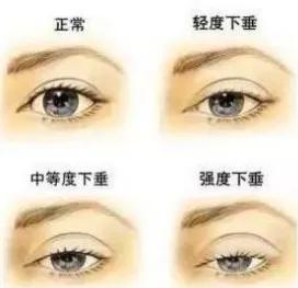 总觉得双眼无神,被说双眼无神