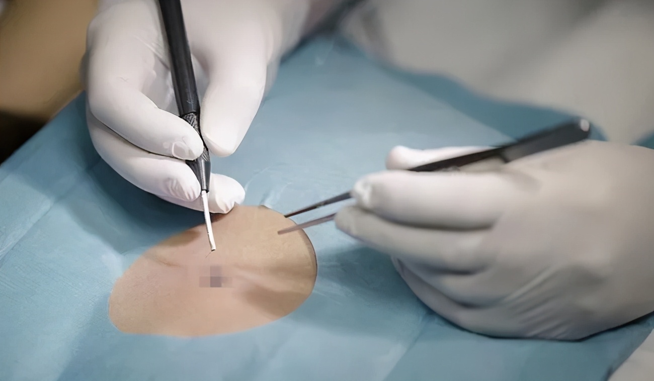 微创手术祛痣全过程,激光祛痣留疤失败案例