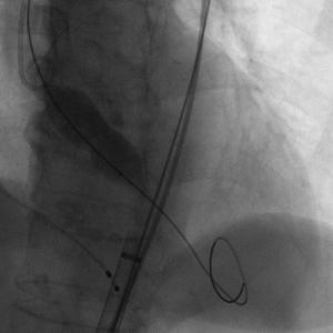 对造影剂过敏如何进行介入治疗,造影剂过敏迟发性治疗