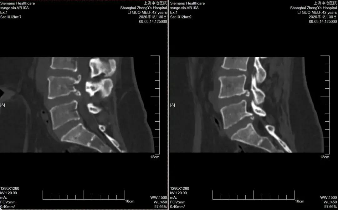 腰疼腿不疼会是椎间盘突出吗,椎间盘突出引起的腰痛怎么治