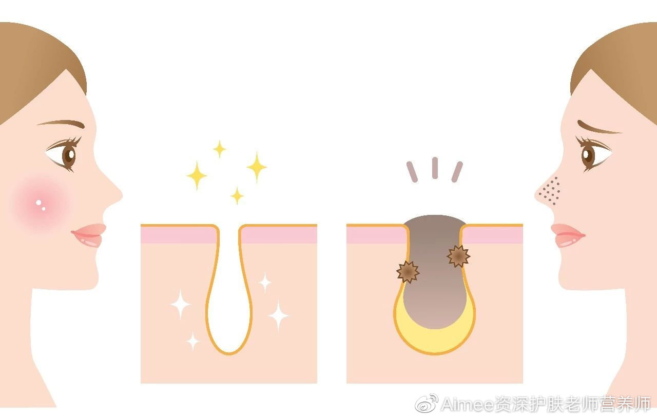 别瞎治了！痘痘的治疗原则是这4点