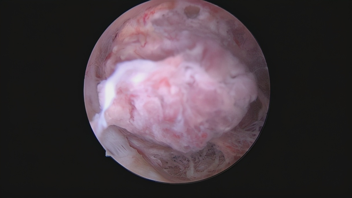 安徽宫腔镜手术专家排名,安徽省立宫腔镜哪个医生做的好