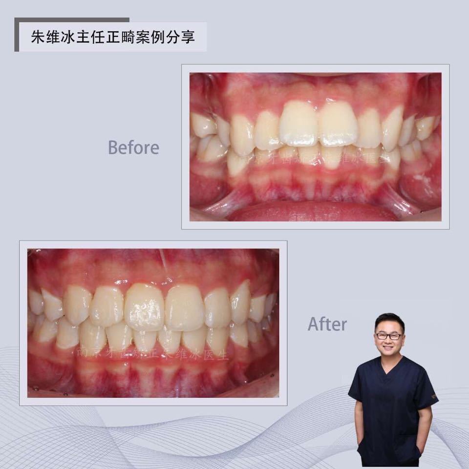 南京正畸朱维冰怎么样,南京牙齿正畸矫正技术