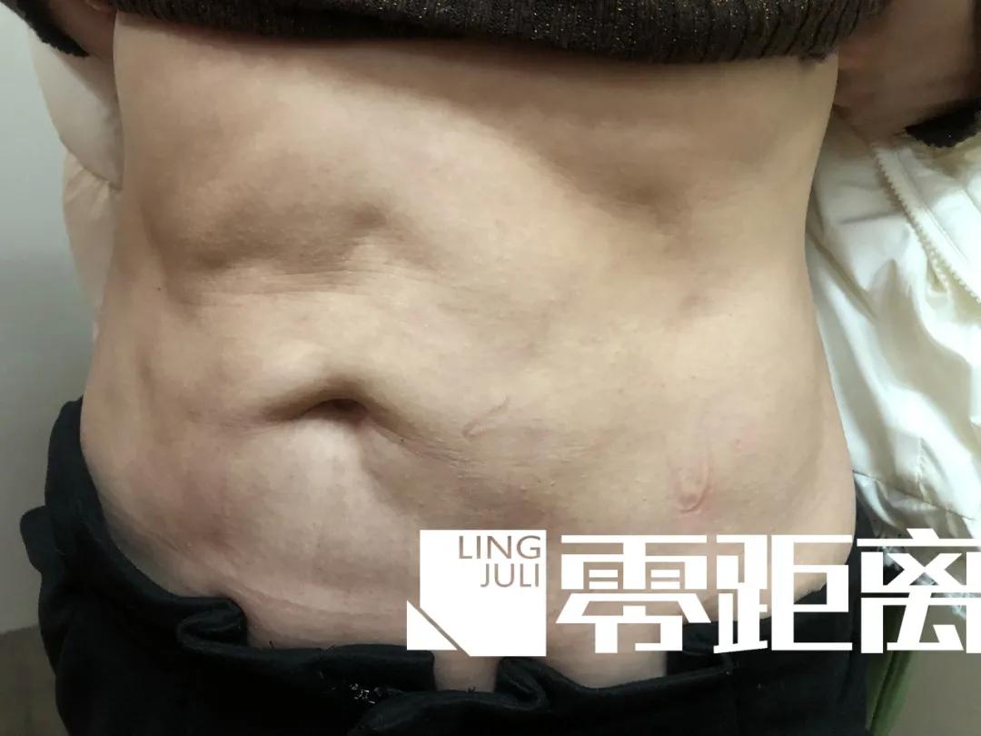 女子抽脂手术后凹凸不平,女子吸脂失败导致大腿凹凸不平