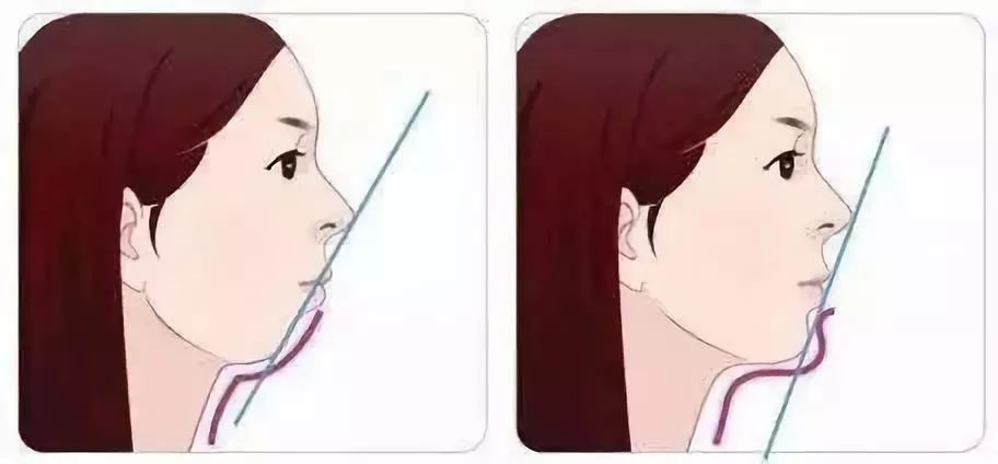 “龅牙”是深覆颌还是深覆盖，两者如何区分？还能不能治疗？